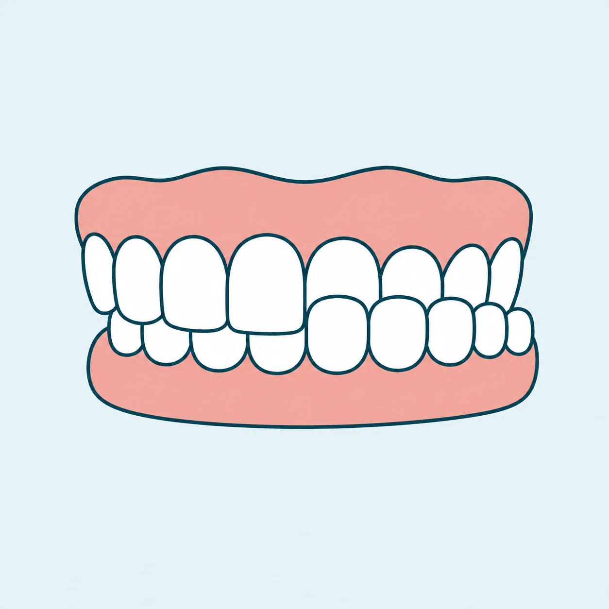 Crossbite