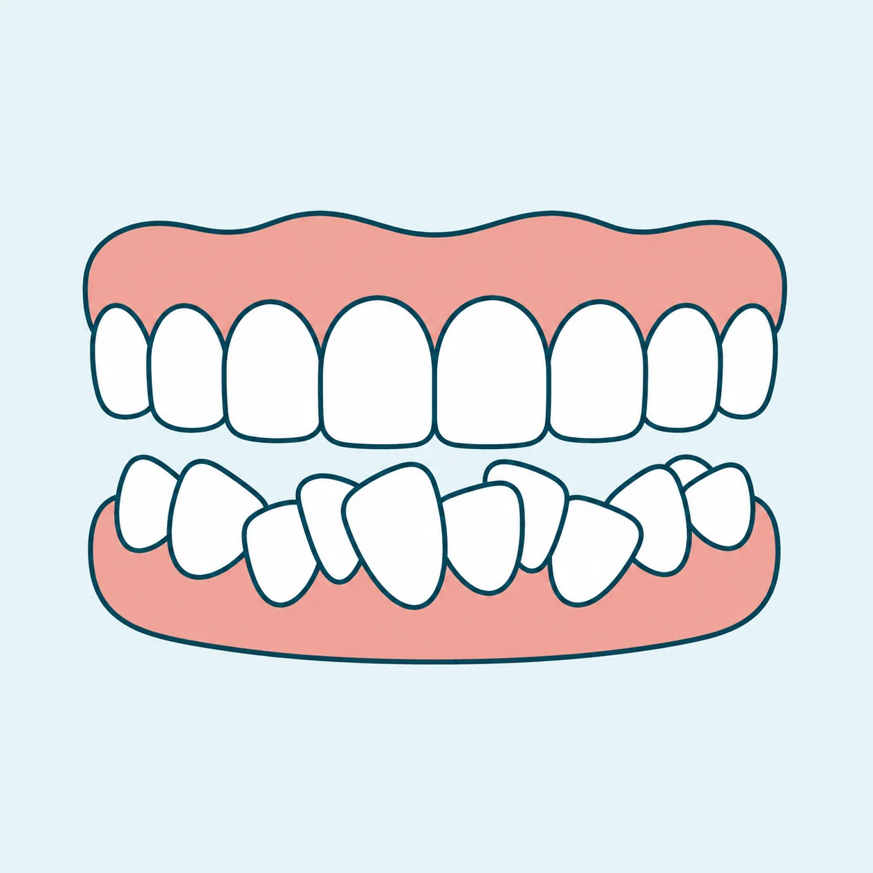 Crowded Teeth