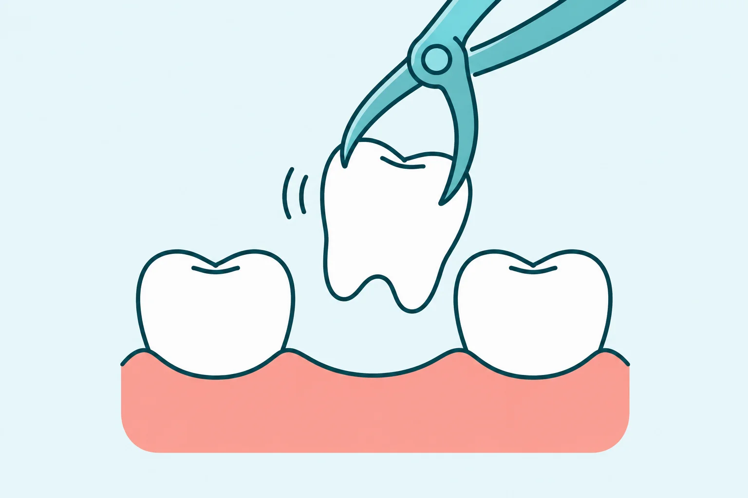Tooth Extraction