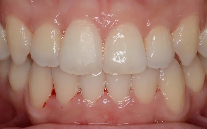 Pendakap Lutsinar Invisalign — foto selepas rawatan: hasil pesakit sebenar di Happy Tooth Dental Clinic, Puchong