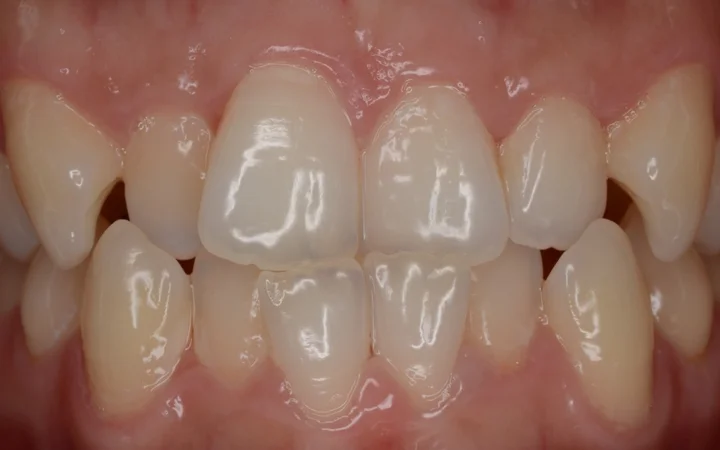 Pendakap Lutsinar Invisalign — foto sebelum rawatan: pesakit sebenar di Happy Tooth Dental Clinic, Puchong