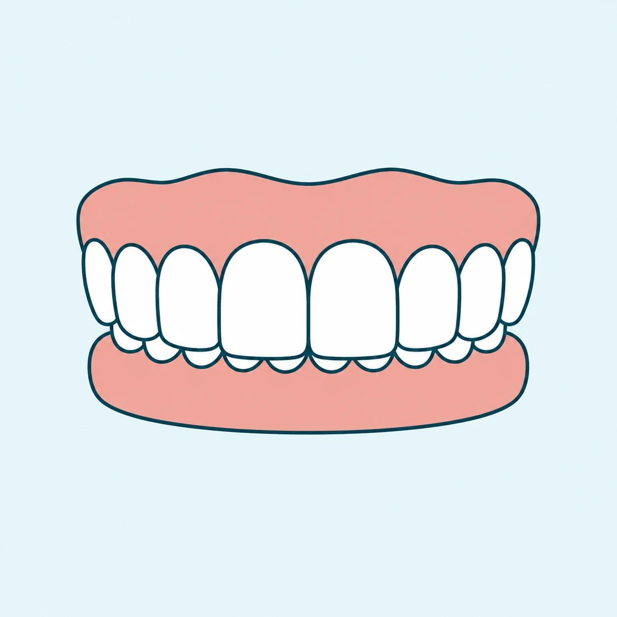 Overbite