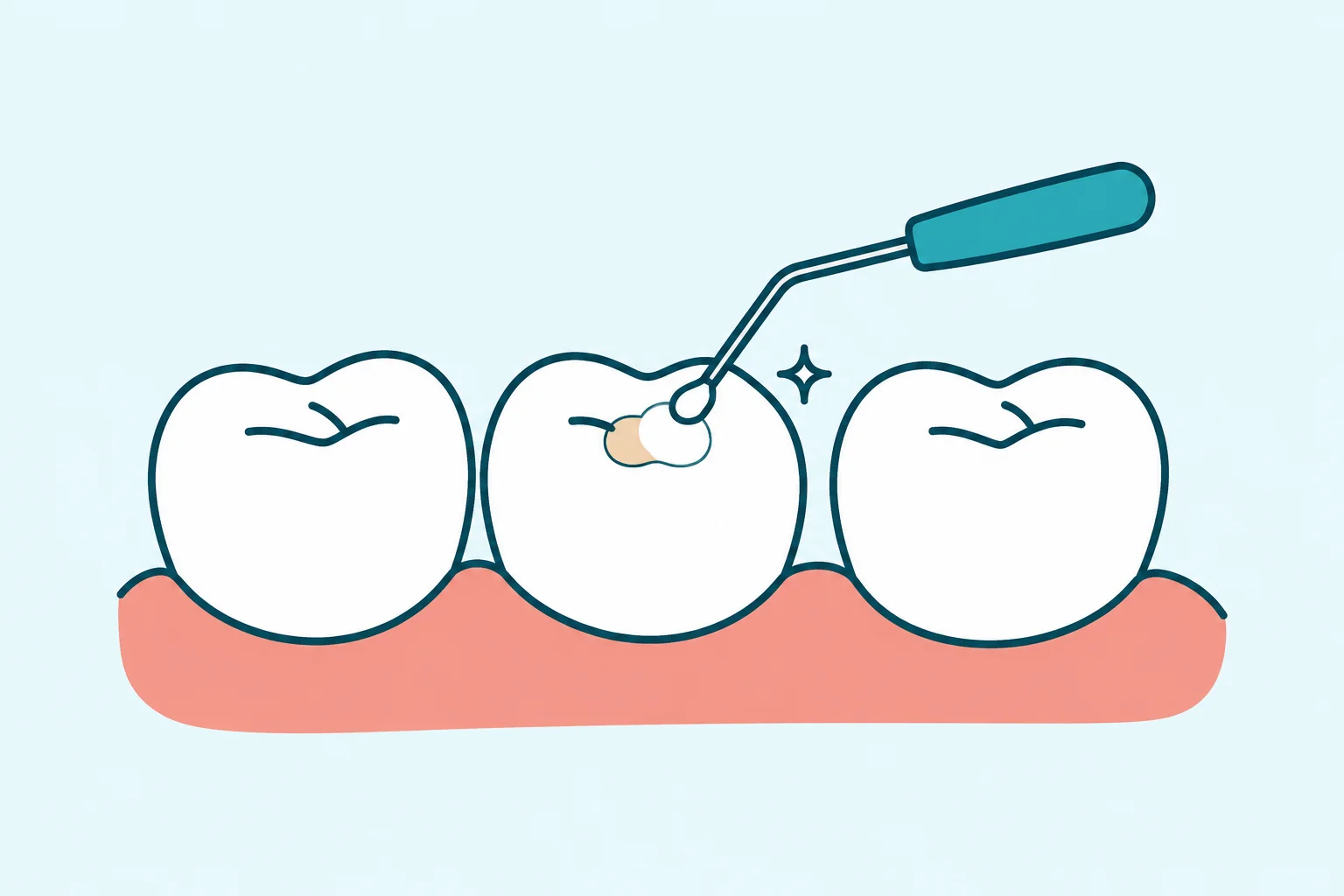 Tooth Fillings
