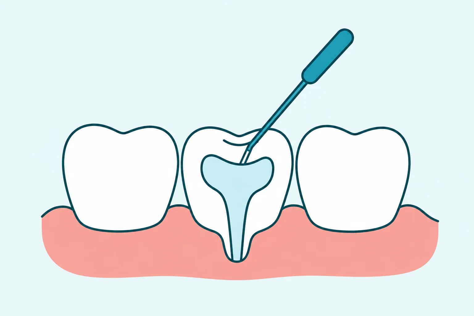 Root Canal Treatment