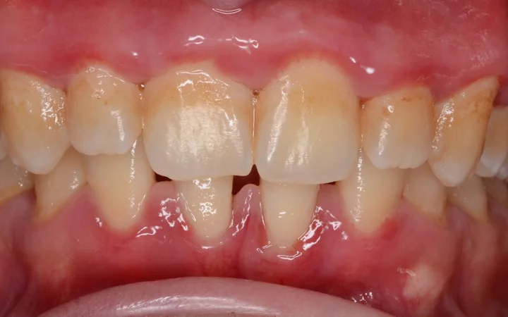 Scaling & Polishing — foto selepas rawatan: hasil pesakit sebenar di Happy Tooth Dental Clinic, Puchong