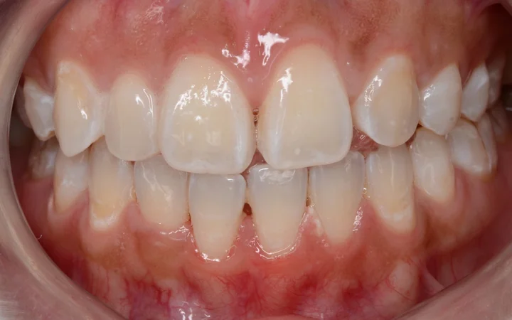 Scaling & Pemutihan Ekspres — foto selepas rawatan: hasil pesakit sebenar di Happy Tooth Dental Clinic, Puchong