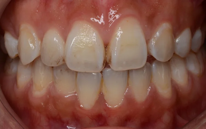 Scaling & Pemutihan Ekspres — foto sebelum rawatan: pesakit sebenar di Happy Tooth Dental Clinic, Puchong