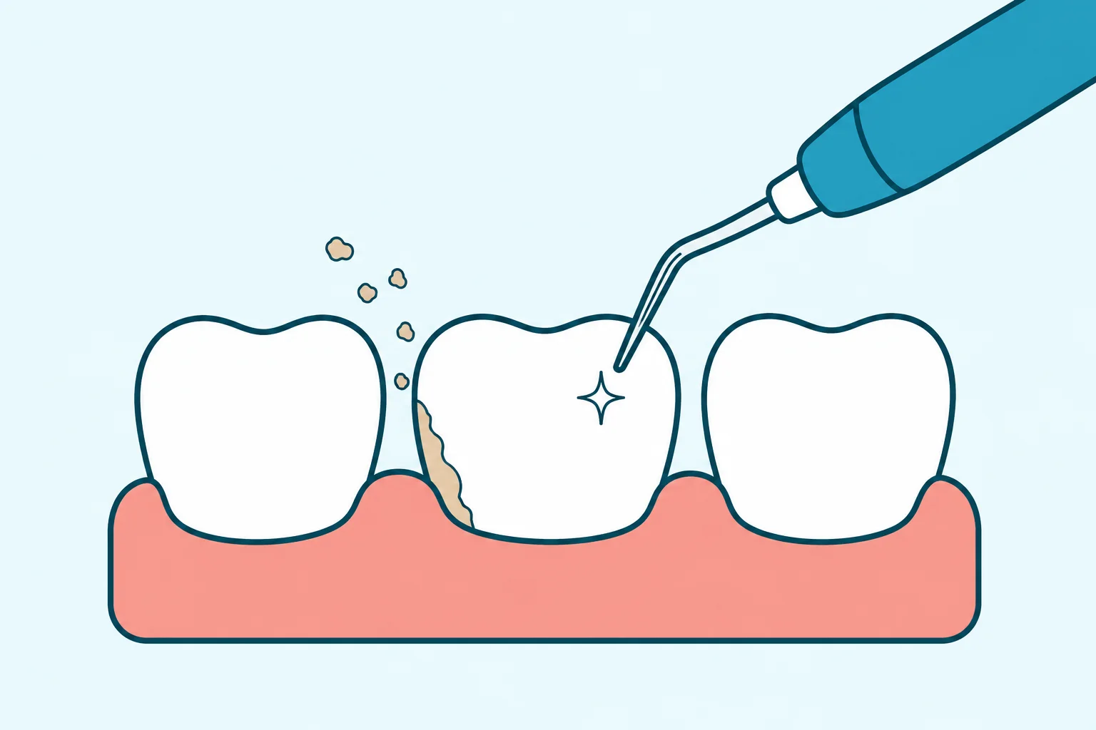 Teeth Scaling & Polishing