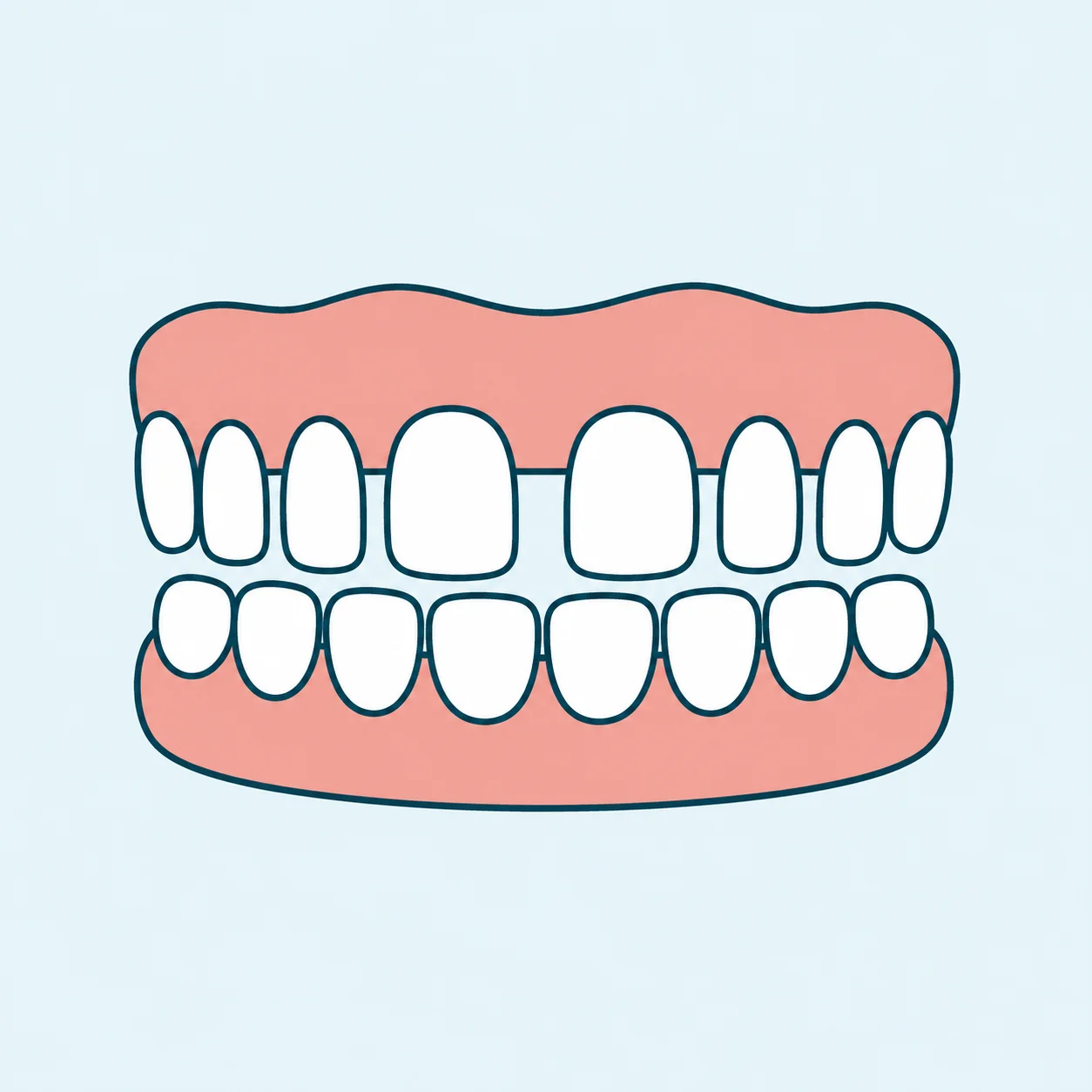 Gapped Teeth