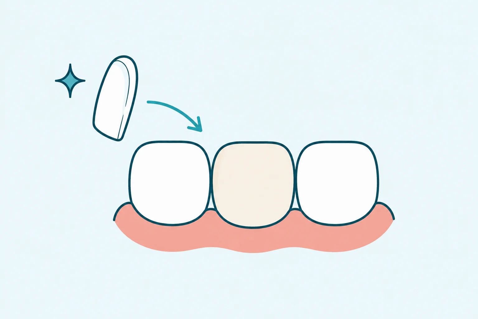 Veneers