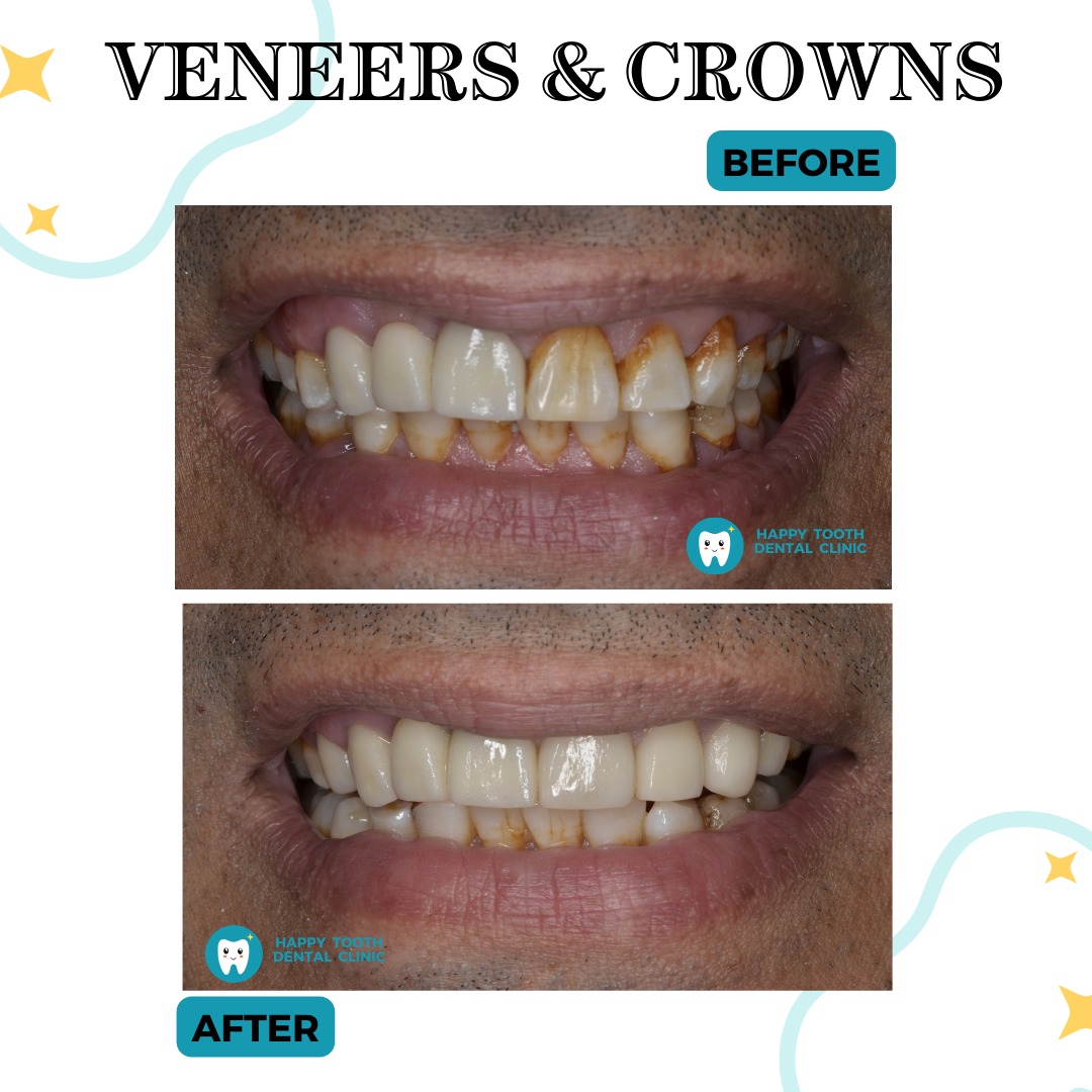 veneers & crowns